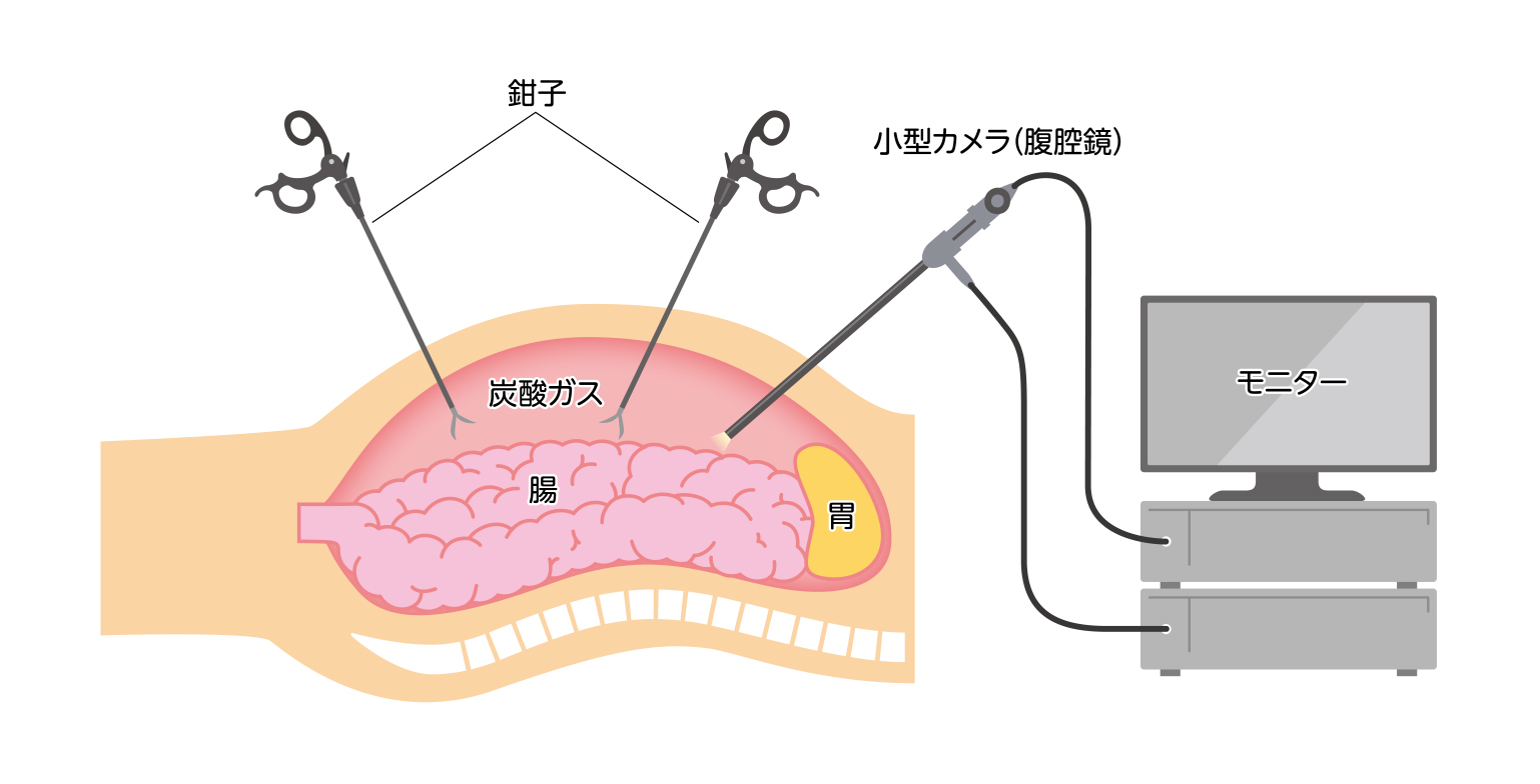 身近な病気ほど負担の少ない手術に｜学習ブログ｜ASP Japan合同会社